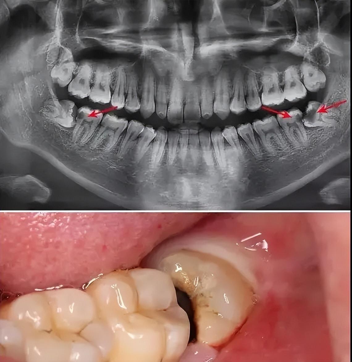 智齒拔除，全面解析智齒拔除前后的注意事項(xiàng)，智齒拔除詳解，前后注意事項(xiàng)全面解析