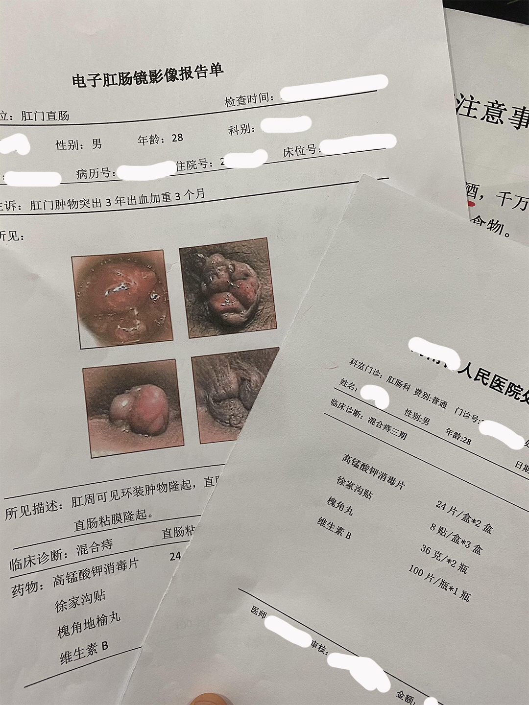 痔瘡肉球，一度、二度、三度的圖片解析與理解，痔瘡肉球，一度、二度、三度癥狀圖片解析及理解指南