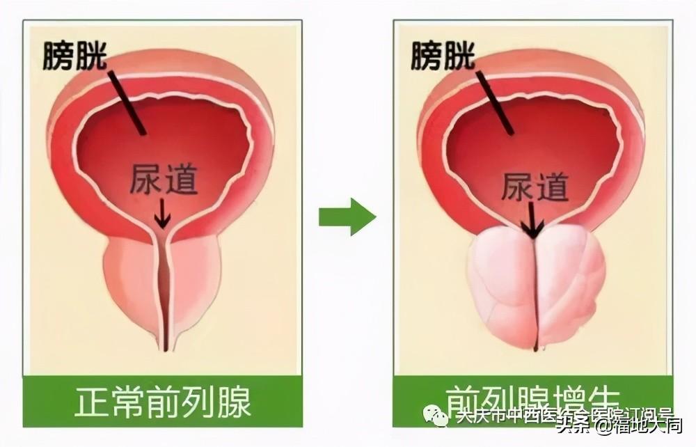 激光碎石費用詳解，究竟需要多少錢？，激光碎石費用全面解析，究竟需要多少費用？