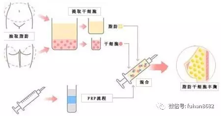 豐胸針一針管幾年與價格解析，豐胸針效果持續(xù)時間與價格解析