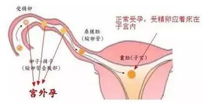 宮外孕早期的七個(gè)征兆