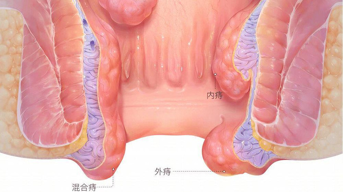 痔瘡土方法一次斷根