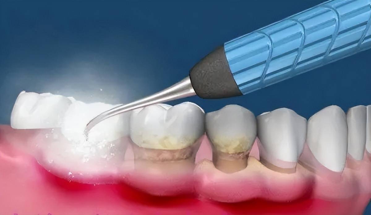 教你自己動(dòng)手清除牙石——輕松打造口腔健康，教你DIY清除牙石，輕松打造口腔健康潔凈環(huán)境