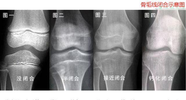 骨骺線閉合后二次長(zhǎng)高的可能性與策略，骨骺線閉合后二次長(zhǎng)高的可能性及策略探討