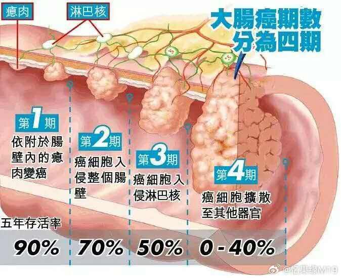 腸癌三多一癢