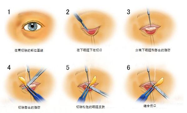 眼綜合手術